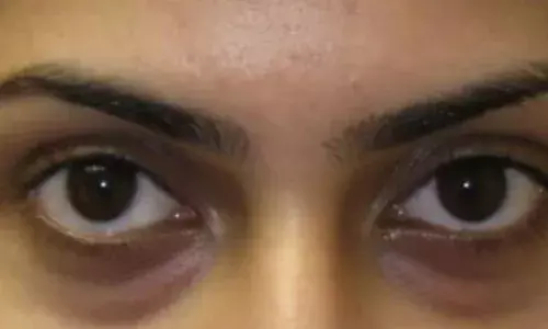 ਜੇਕਰ ਤੁਹਾਡੀਆਂ ਅੱਖਾਂ ਹੇਠਾਂ ਹੈ ਬਲੈਕ ਸਰਕਲ ਤਾਂ ਆਪਣਾਓ ਇਹ ਟਿਪਸ