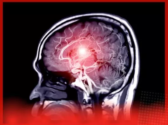 ਇੱਕੋ ਹਸਪਤਾਲ ਦੀਆਂ 10 ਤੋਂ ਵੱਧ ਨਰਸਾਂ ਨੂੰ ਬ੍ਰੇਨ ਹੋਇਆ ਟਿਊਮਰ, ਡਾਕਟਰ ਵੀ ਚਿੰਤਤ