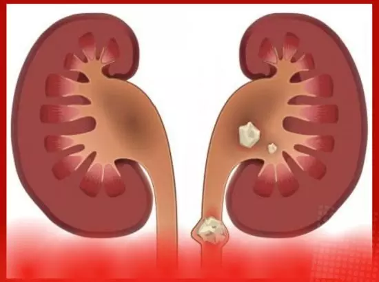 ਗੁਰਦੇ ਦੀ ਪੱਥਰੀ ਬਣਨ ਦੇ ਮੁੱਖ ਕਾਰਨ ਗੁਰਦੇ ਦੀ ਪੱਥਰੀ ਬਣਨ ਦੇ ਮੁੱਖ ਕਾਰਨ