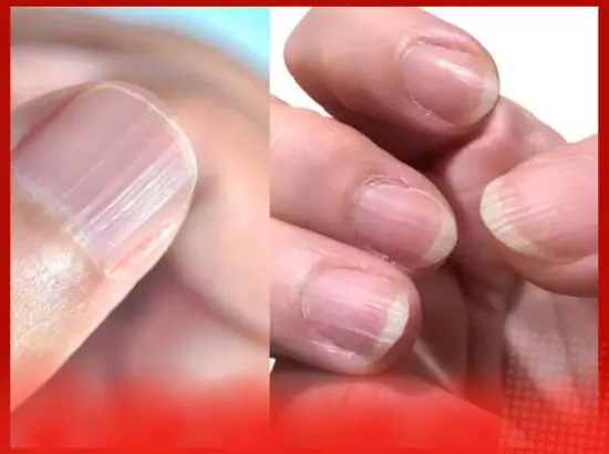 ਨਹੁੰਆਂ ਤੇ ਲਾਈਨਾਂ ਦਾ ਦਿਖਾਈ ਦੇਣਾ ਕੀ ਦਰਸਾਉਂਦਾ ਹੈ? ਸਰੀਰ ਵਿਚ ਕੀ ਕਮਤੀ ਹੈ