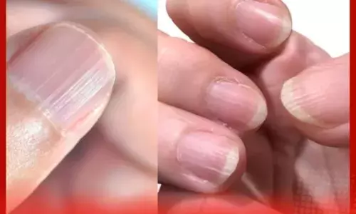 ਨਹੁੰਆਂ ਤੇ ਲਾਈਨਾਂ ਦਾ ਦਿਖਾਈ ਦੇਣਾ ਕੀ ਦਰਸਾਉਂਦਾ ਹੈ? ਸਰੀਰ ਵਿਚ ਕੀ ਕਮਤੀ ਹੈ