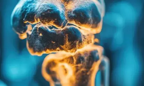 ਨੌਜਵਾਨੀ ਵਿੱਚ ਹੱਡੀਆਂ ਹੋ ਰਹੀਆਂ ਖੋਖਲੀਆਂ: ਭਾਰਤੀ ਨੌਜਵਾਨਾਂ ਵਿੱਚ ਓਸਟੀਓਪੋਰੋਸਿਸ ਦਾ ਵਧਦਾ ਖ਼ਤਰਾ