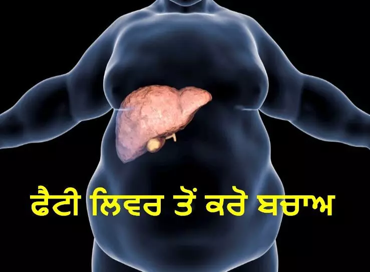 ਫ਼ੈਟੀ ਲਿਵਰ ਬਣਦਾ ਜਾ ਰਿਹਾ ਹੈ ਮਹਾਂਮਾਰੀ ਫ਼ੈਟੀ ਲਿਵਰ ਬਣਦਾ ਜਾ ਰਿਹਾ ਹੈ ਮਹਾਂਮਾਰੀ