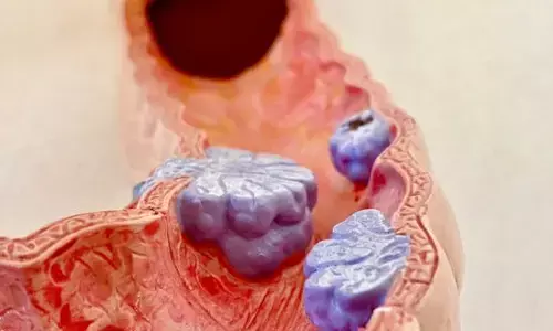 ਅੰਤੜੀਆਂ ਦਾ ਕੈਂਸਰ (Colon Cancer): ਲੱਛਣ, ਕਾਰਨ ਅਤੇ ਬਚਾਅ ਦੇ ਤਰੀਕੇ