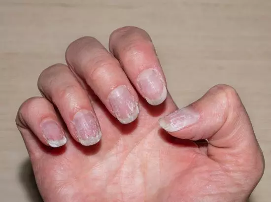 Health tips : ਨਹੁੰਆਂ ਦਾ ਬਦਲਦਾ ਰੰਗ ਕਿਸੇ ਗੰਭੀਰ ਬਿਮਾਰੀ ਵੱਲ ਇਸ਼ਾਰਾ ਕਰ ਸਕਦੀ ? Health tips : ਨਹੁੰਆਂ ਦਾ ਬਦਲਦਾ ਰੰਗ ਕਿਸੇ ਗੰਭੀਰ ਬਿਮਾਰੀ ਵੱਲ ਇਸ਼ਾਰਾ ਕਰ ਸਕਦੀ ?