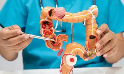 Health Tips - ਸਾਵਧਾਨ! ਅੰਤੜੀਆਂ ਦੀਆਂ ਇਹ 2 ਗੰਢਾਂ ਵਧਾ ਸਕਦੀਆਂ ਹਨ ਕੈਂਸਰ ਦਾ ਖ਼ਤਰਾ Health Tips - ਸਾਵਧਾਨ! ਅੰਤੜੀਆਂ ਦੀਆਂ ਇਹ 2 ਗੰਢਾਂ ਵਧਾ ਸਕਦੀਆਂ ਹਨ ਕੈਂਸਰ ਦਾ ਖ਼ਤਰਾ